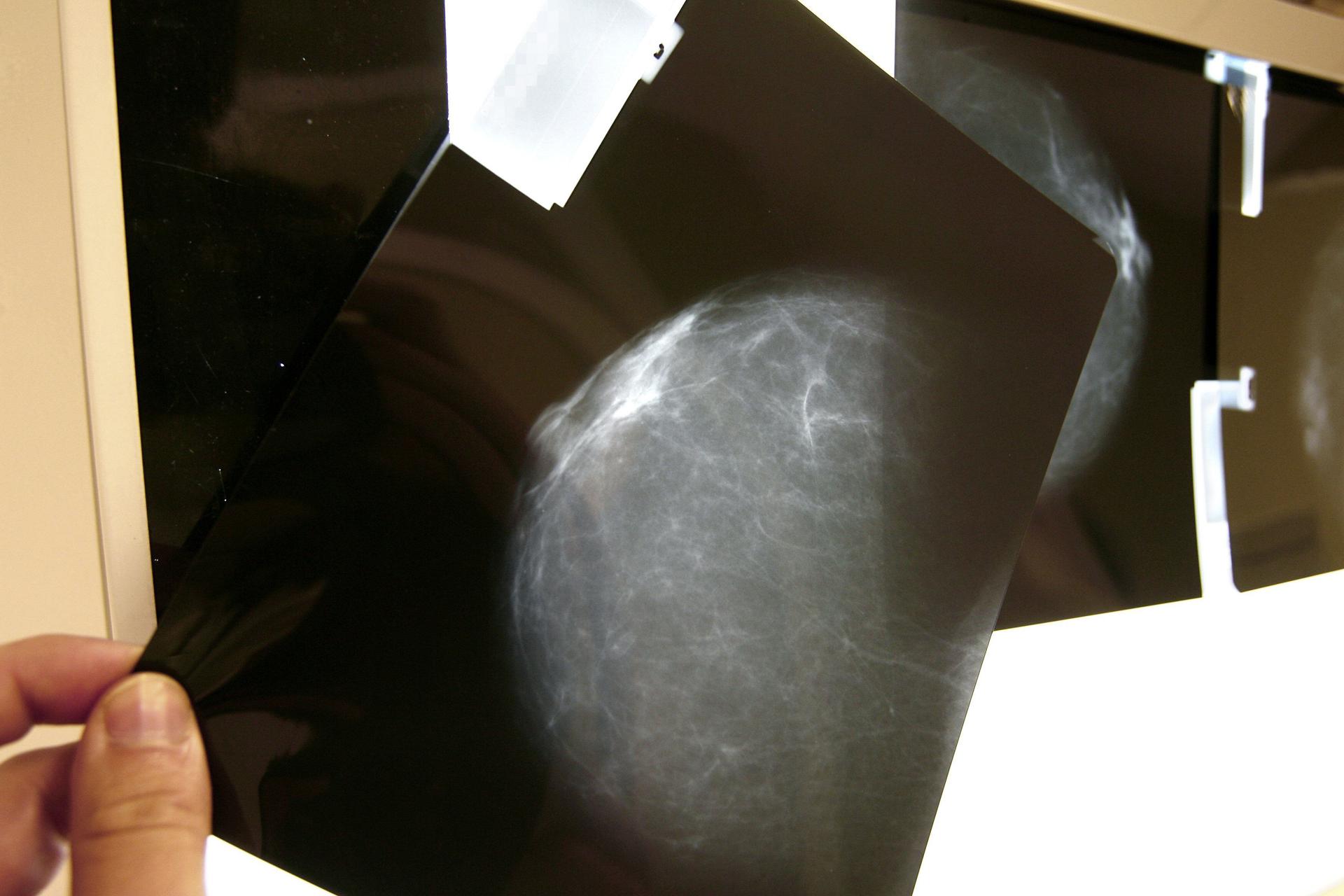Una de cada 20 mujeres padecerá cáncer de mama y una de cada 70 morirá por esta causa