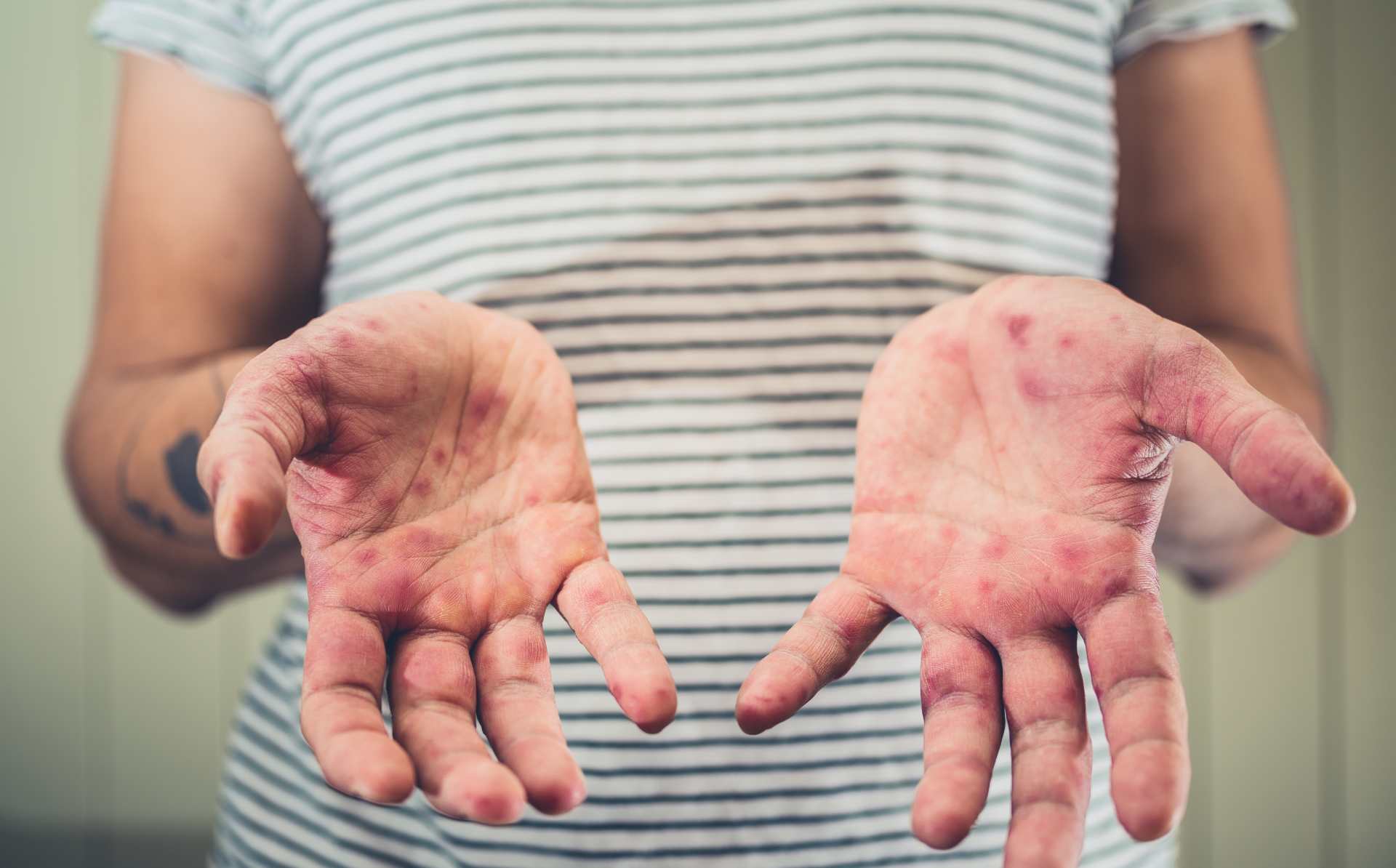 Reportan desde enero 308 casos de sarampión en EE.UU. y superan el total de 2024