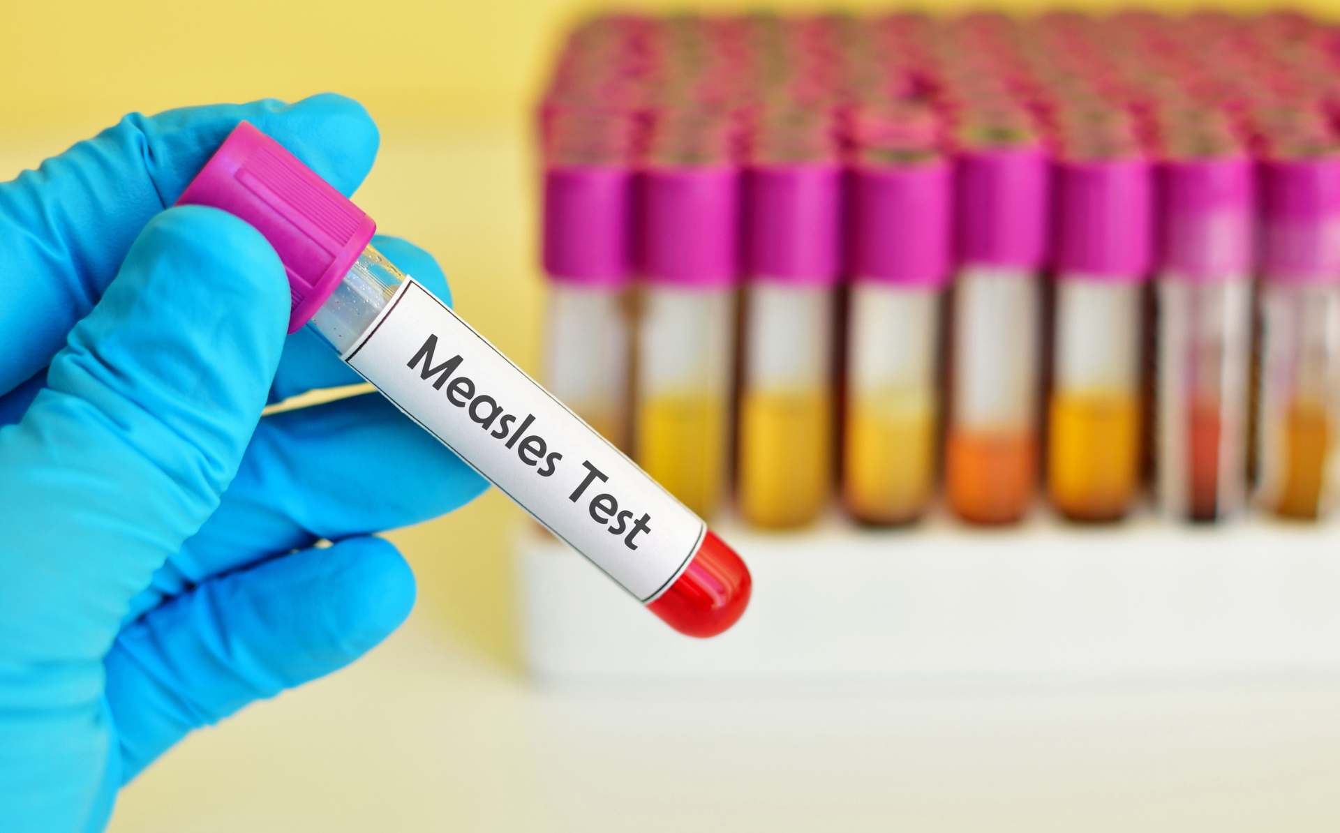 Utah confirma 11 casos de sarampión en 2025 y descarta contagios activos