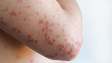 Utah enfrenta aumento de casos de sarampión: confirman ocho contagios en estudiantes de Wasatch High