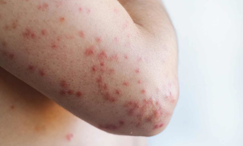 Utah enfrenta aumento de casos de sarampión: confirman ocho contagios en estudiantes de Wasatch High