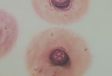 Arte que reconstruye identidad: EOLA MedArt y el impacto emocional de las prótesis de pezón hiperrealistas (+VIDEOS)