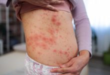 Brote de sarampión en Utah se expande desde 2025 y refuerza el llamado a la vacunación