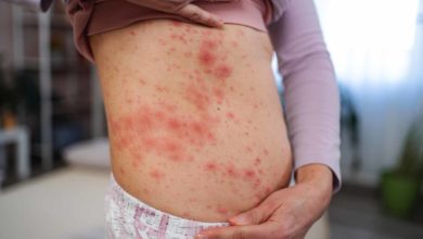 Brote de sarampión en Utah se expande desde 2025 y refuerza el llamado a la vacunación