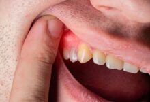 La inflamación y otras enfermedades pueden empezar en la boca: Una alerta que no debe ignorarse